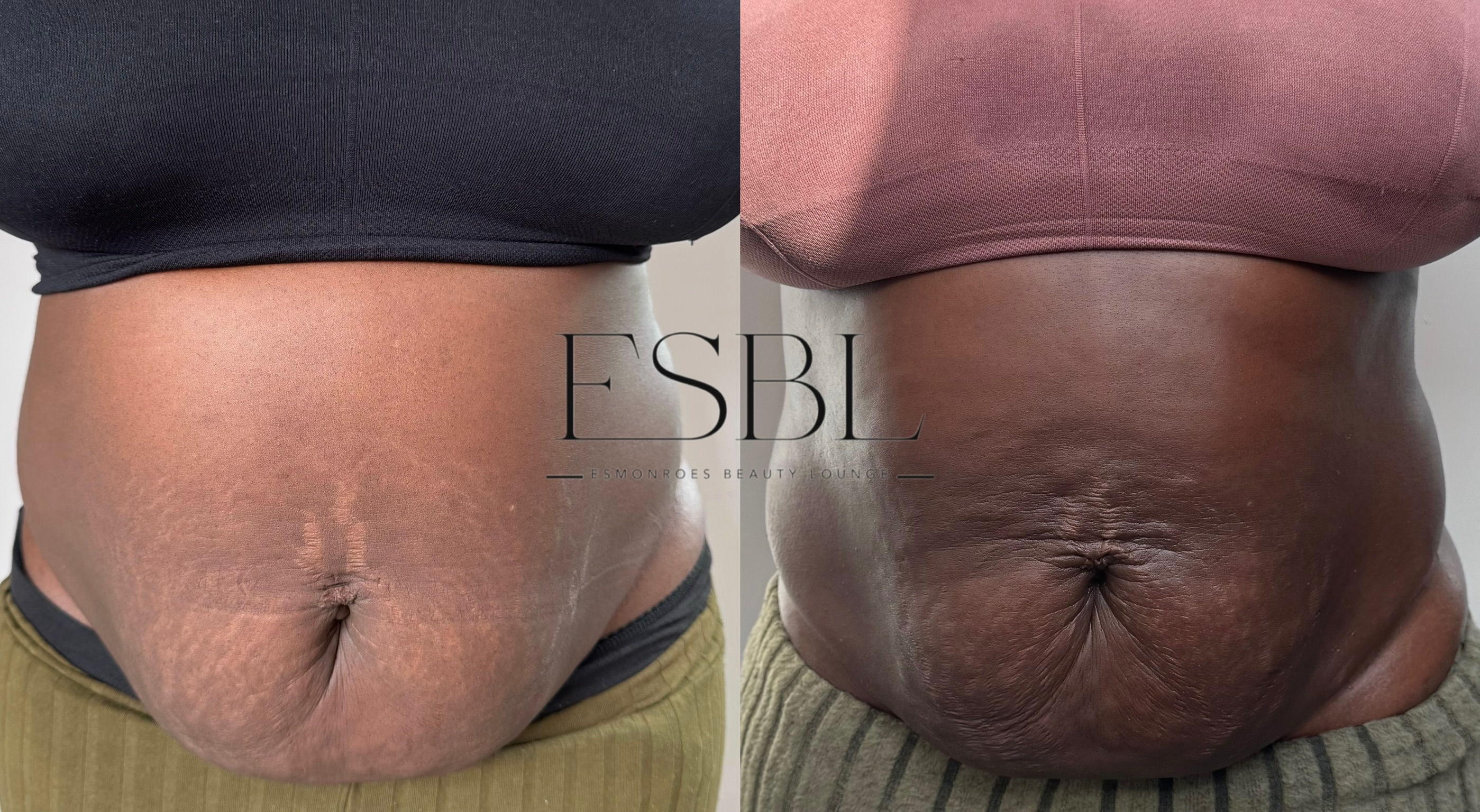 ES-Sculpt client result after 3 sessions