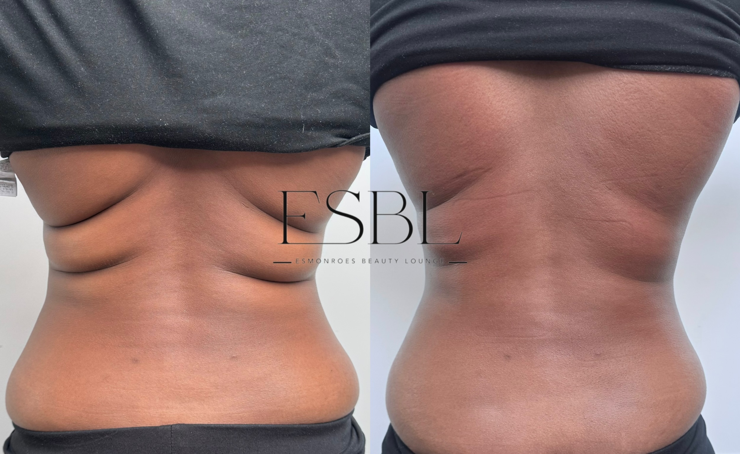 ES-Sculpt client result after 1 session
