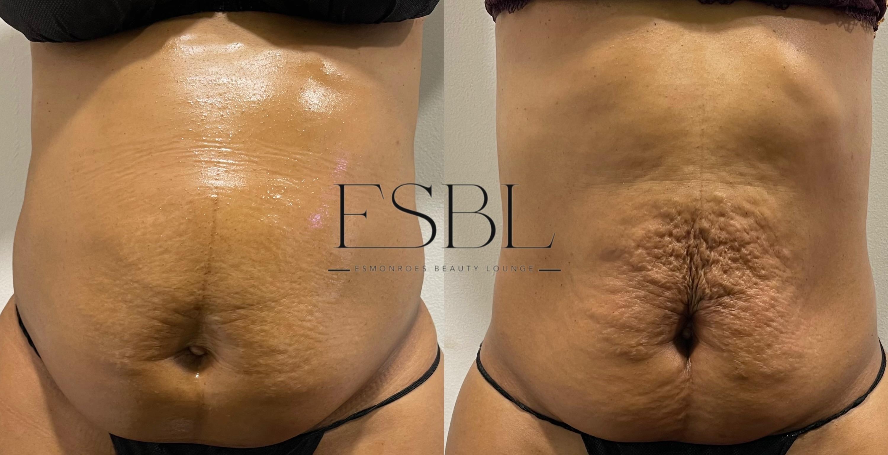 ES-Sculpt client result after 5 sessions