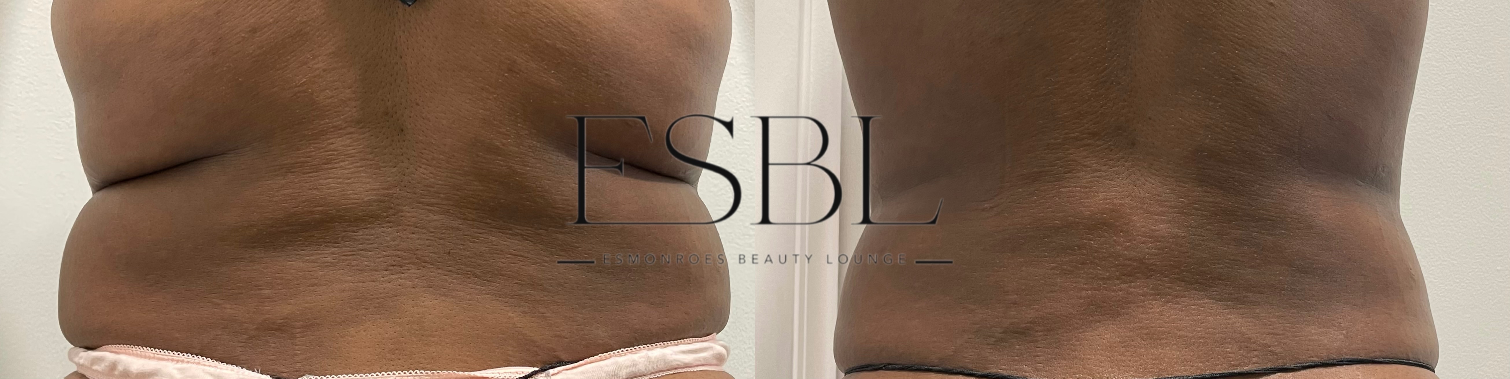 ES-Sculpt client result after 2 sessions