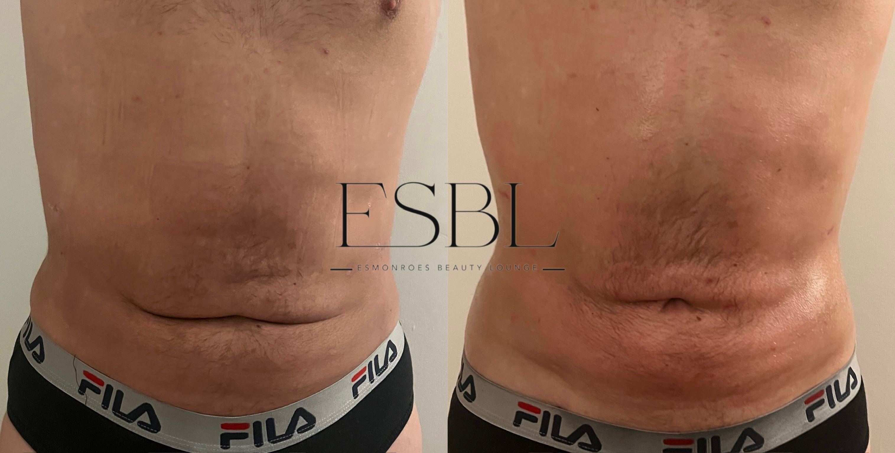 Post-operative maintenance client result after 2 sessions