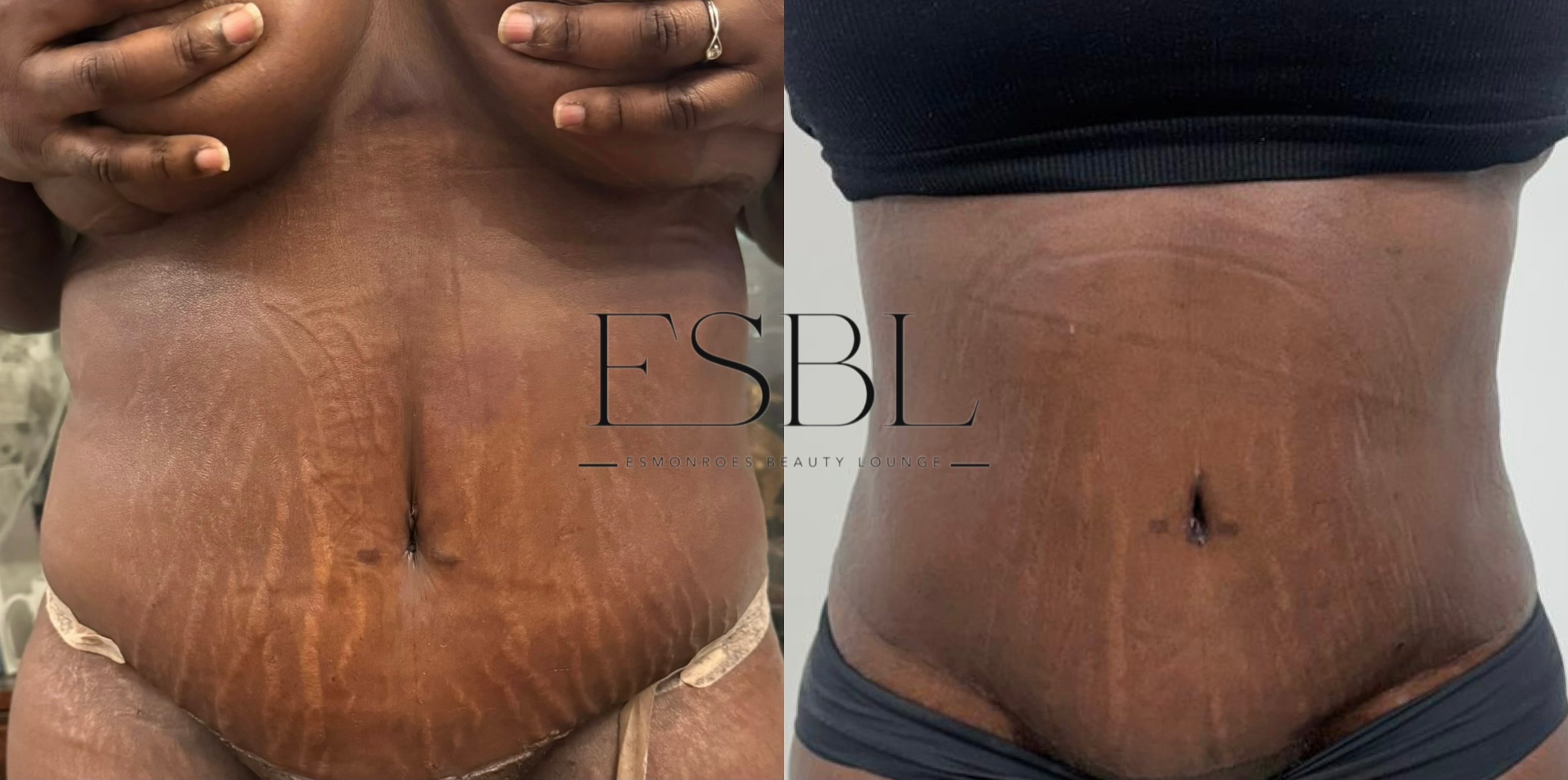 Lymphatic drainage client result after 10 sessions