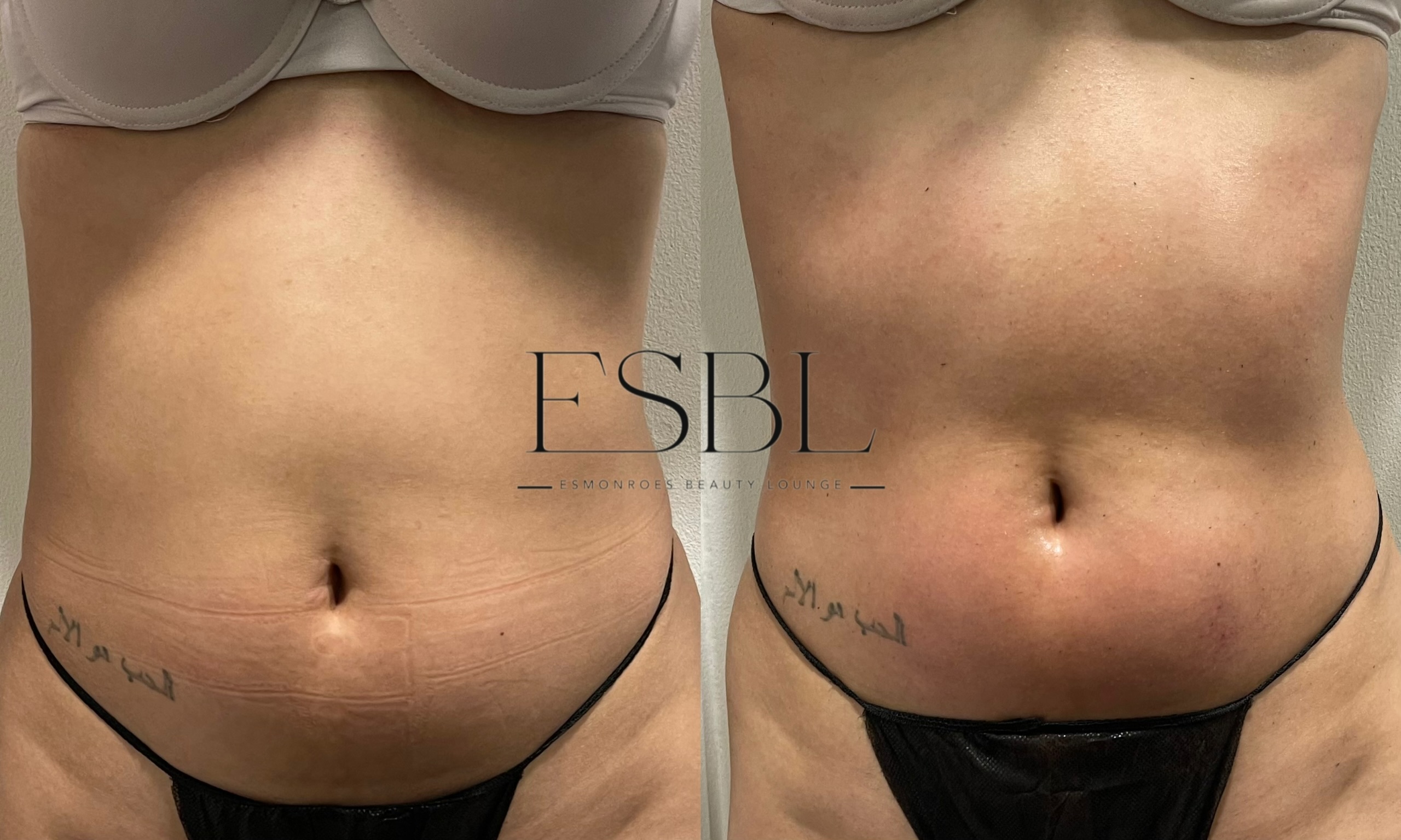 ES-Sculpt client result after 1 session