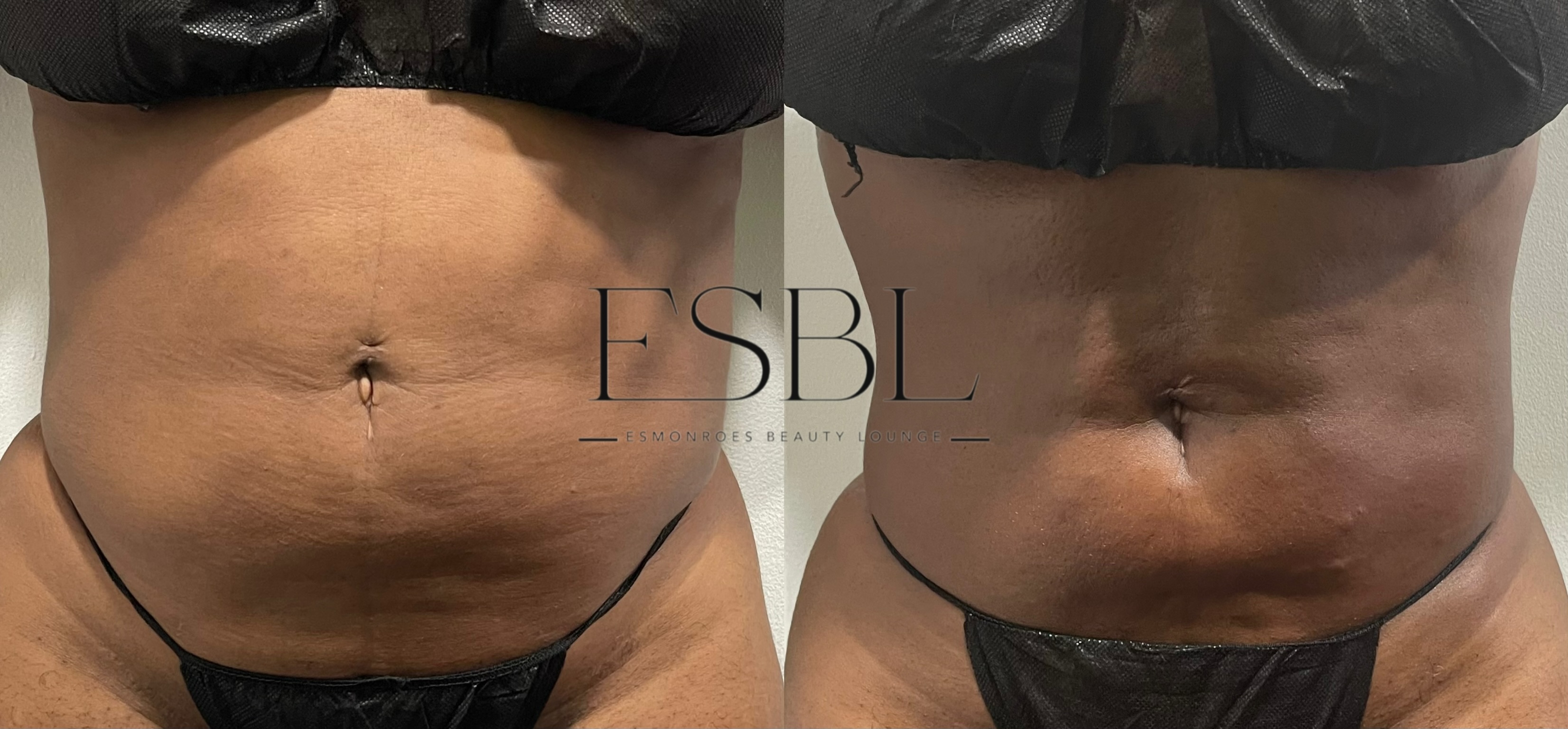 Post-operative maintenance client result after 1 session