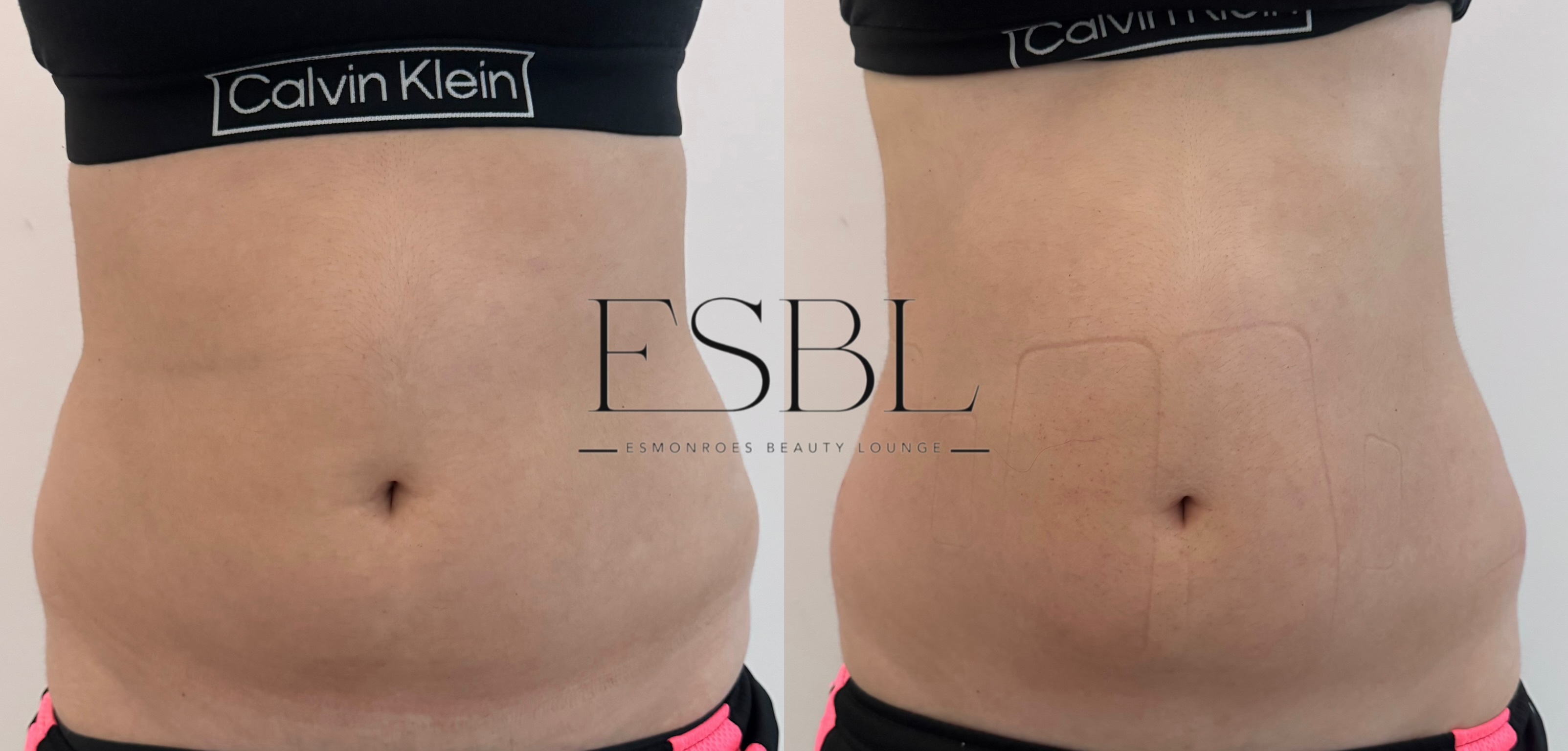 Body Contouring Consultation