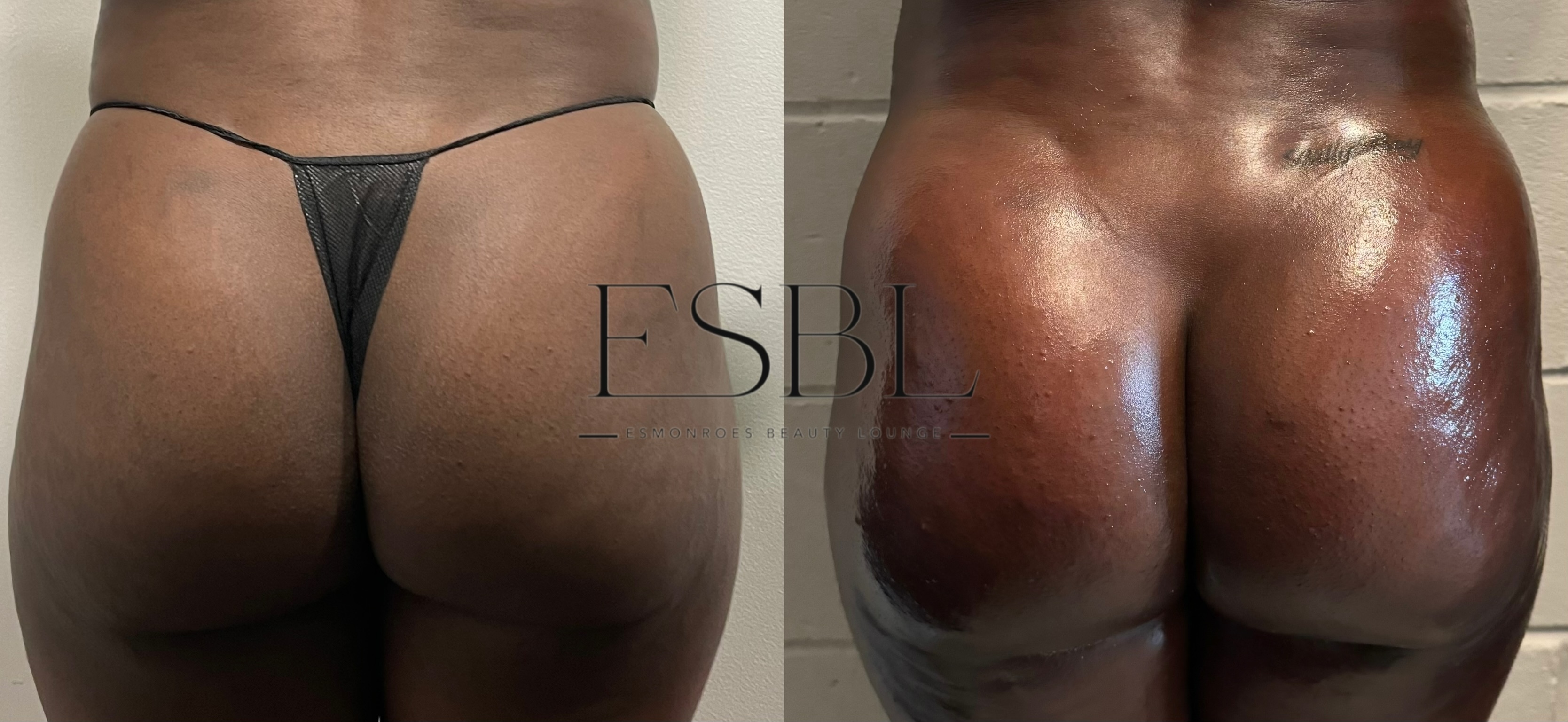 ES-Booty Builder | Non-Surgical Booty Enhancement