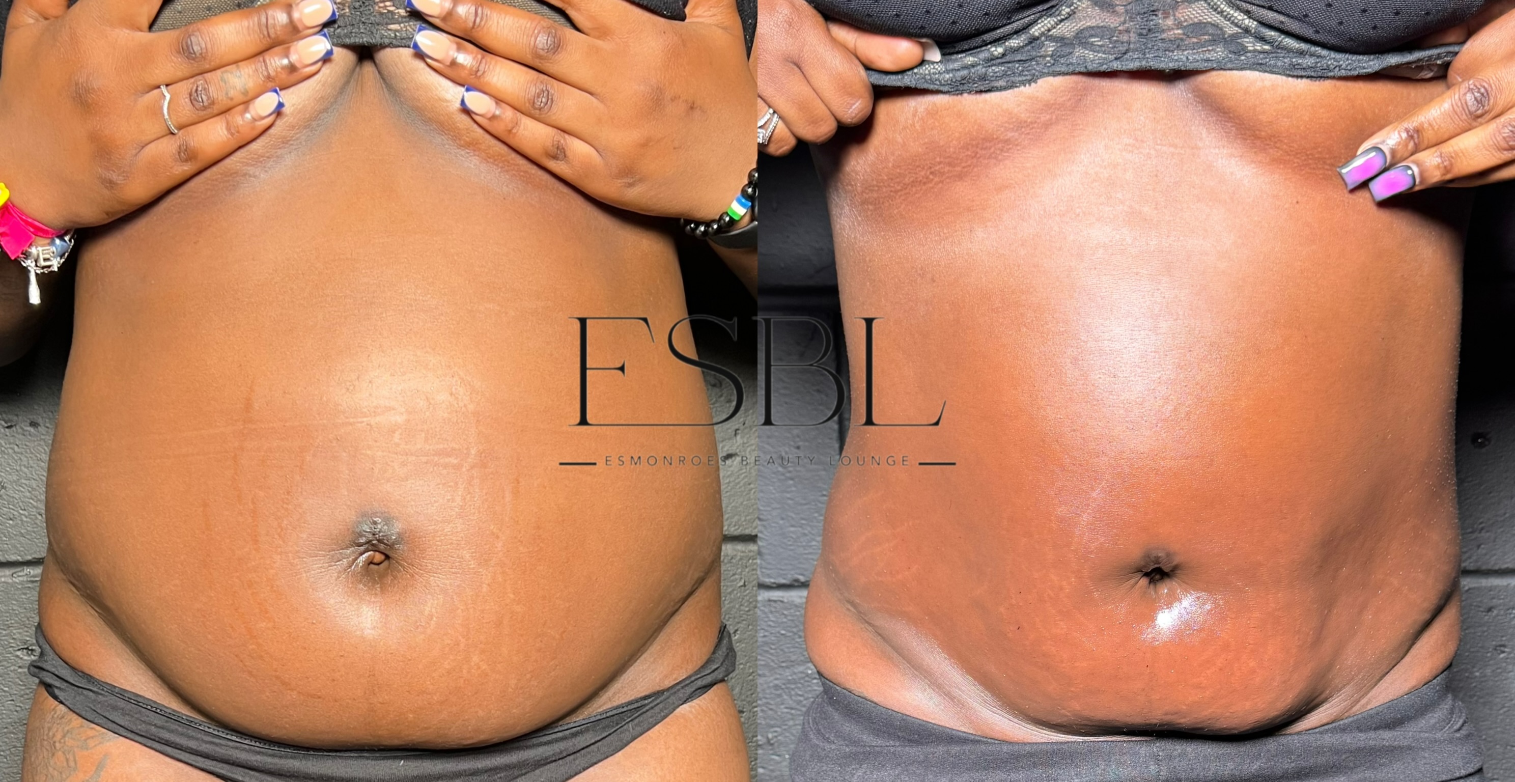 ES-Melt | Body Contouring