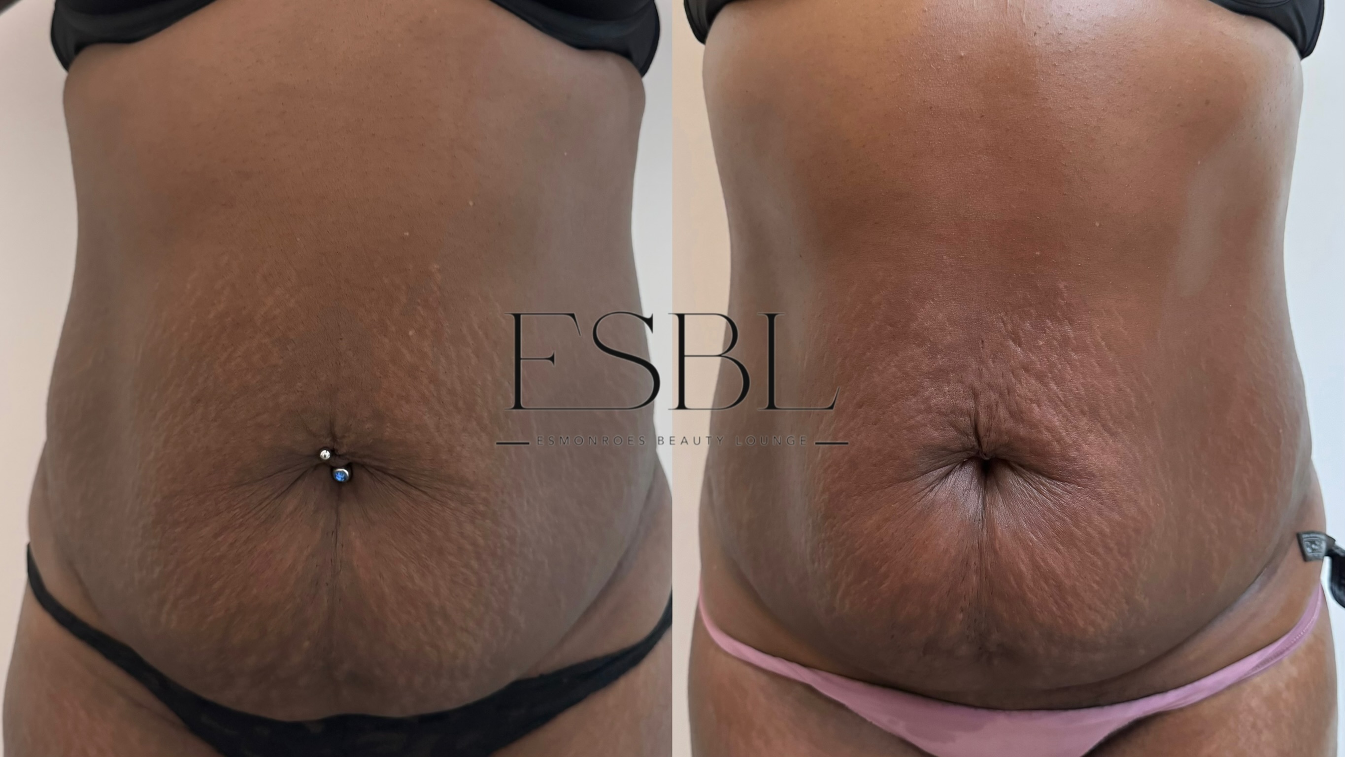 ES-Sculpt | 360° Body Contouring