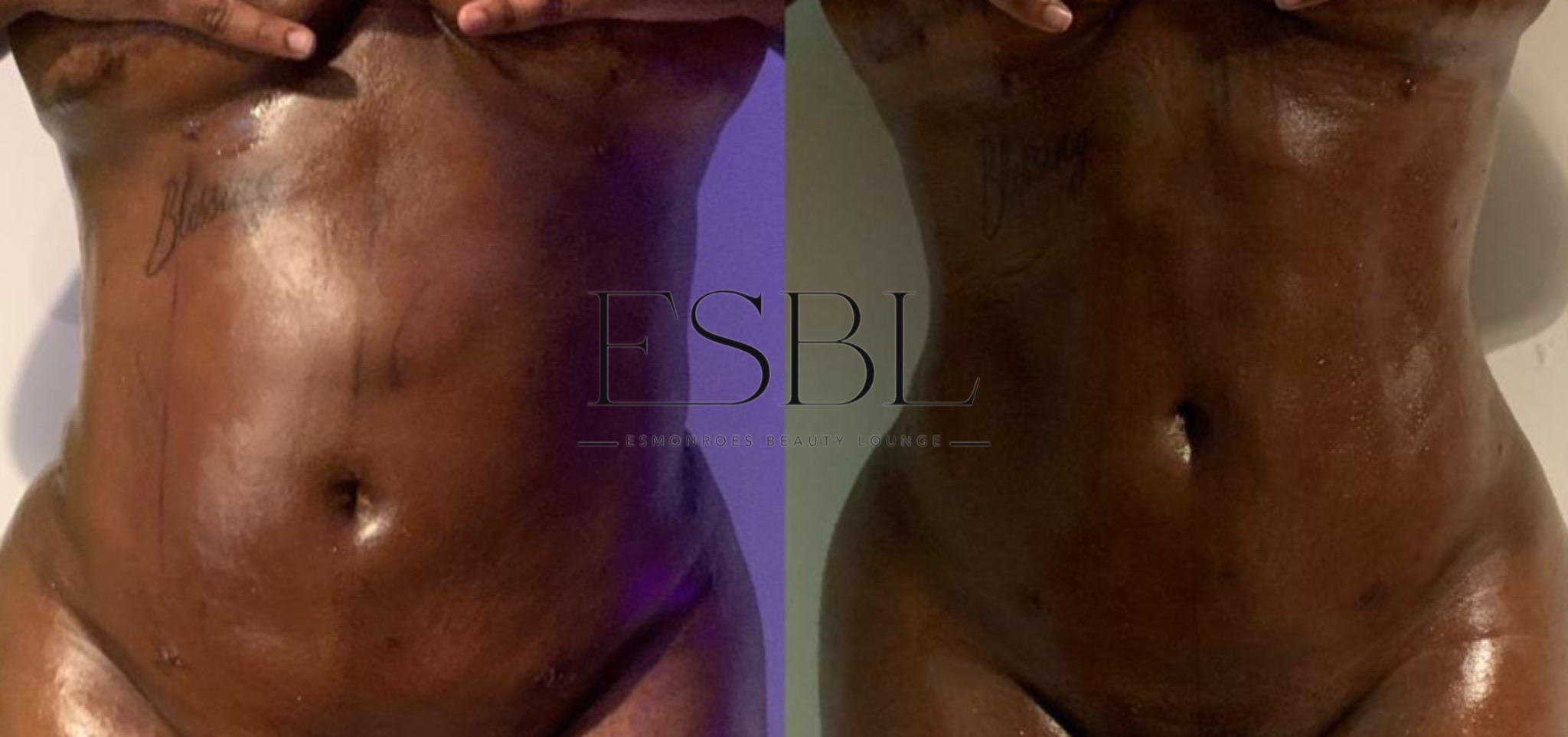 Post-Operative Lymphatic Drainage